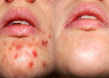 Acne Laser Treatment